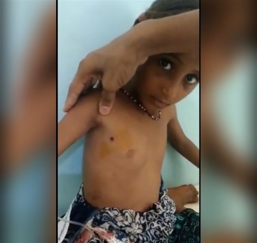 مقتل طفل وإصابة آخر بانفجار قنبلة جنوب الحديدة