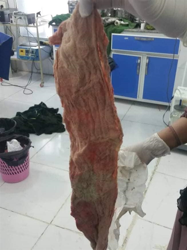 مستشفى في إب يتوعد مريضة وابنها بالطرد بعد اكتشاف شاش تركوه بداخلها