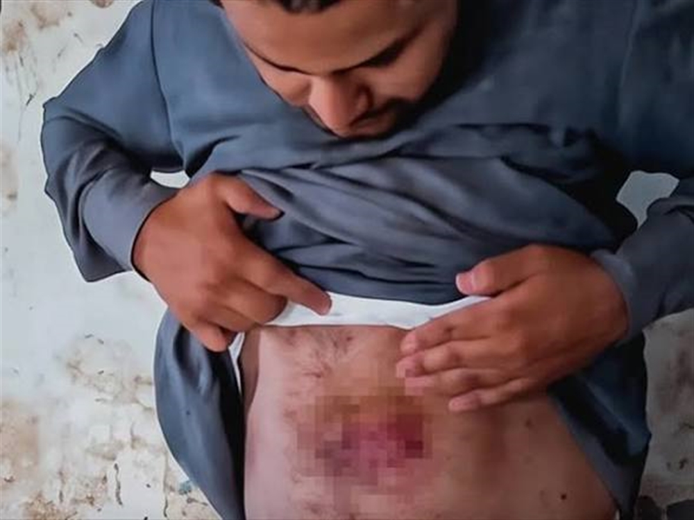 مليشيا الحوثي تعذب مختطف بسجن قحزة في صعدة