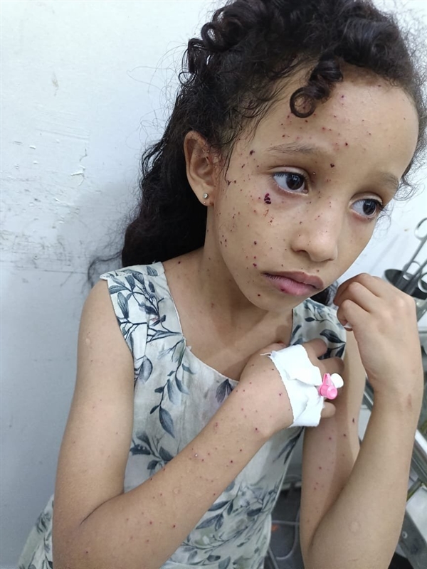 إصابة طفلة بقذيفة حوثية استهدفت منزلاً في المطار القديم غربي تعز